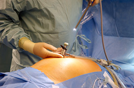 Laparoscopic Keyhole Surgery - General Surgery